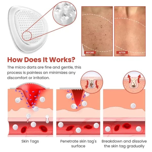 Derma Smooth Skin Tag Removal Patch _ 72 Patches