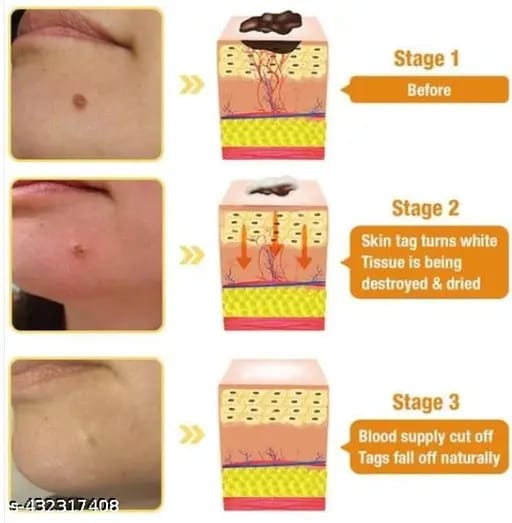 Derma Smooth Skin Tag Removal Patch _ 72 Patches